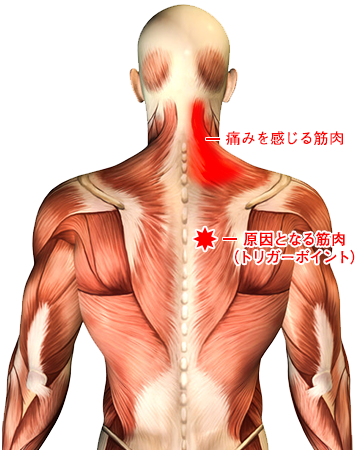 痛みの原因を見つけて改善するトリガーポイント治療